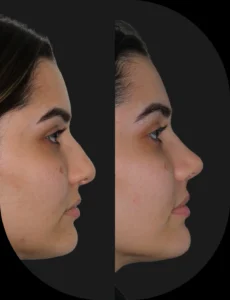 Antes e depois de rinoplastia realizada pelo Dr. Henrique Friedrich — caso 1, vista de perfil