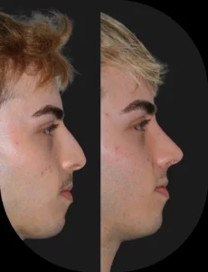 Antes e depois de rinoplastia realizada pelo Dr. Henrique Friedrich — caso 2, vista de perfil