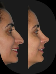 Antes e depois de rinoplastia realizada pelo Dr. Henrique Friedrich — caso 3, vista de perfil