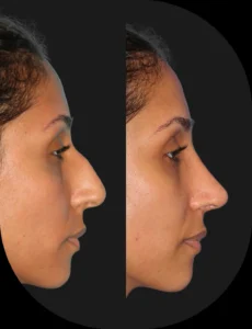 Antes e depois de rinoplastia realizada pelo Dr. Henrique Friedrich — caso 4, vista de perfil