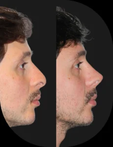 Antes e depois de rinoplastia realizada pelo Dr. Henrique Friedrich — caso 5, vista de perfil