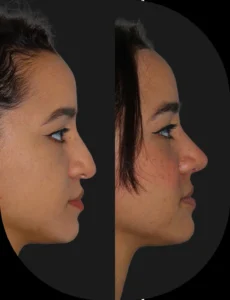 Antes e depois de rinoplastia realizada pelo Dr. Henrique Friedrich — caso 6, vista de perfil