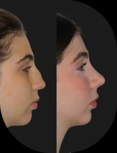 Antes e depois de rinoplastia realizada pelo Dr. Henrique Friedrich — caso 7, vista de perfil