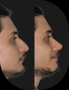 Antes e depois de rinoplastia realizada pelo Dr. Henrique Friedrich — caso 8, vista de perfil