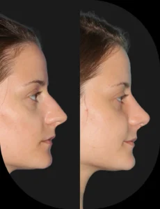 Antes e depois de rinoplastia realizada pelo Dr. Henrique Friedrich — caso 9, vista de perfil